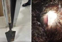 Mulher tem dedo quebrado e sofre cortes na cabeça após ser agredida com pá por homem